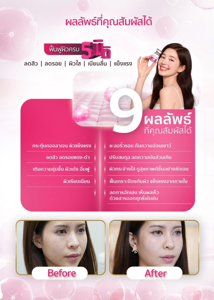 ผลลัพธ์ Before After การรักษาสิวด้วย Super Celeb Glow