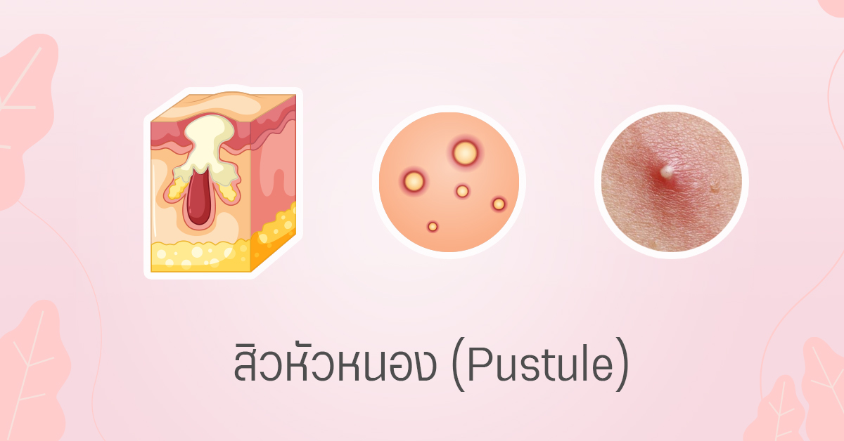 สิวหัวหนอง pustule