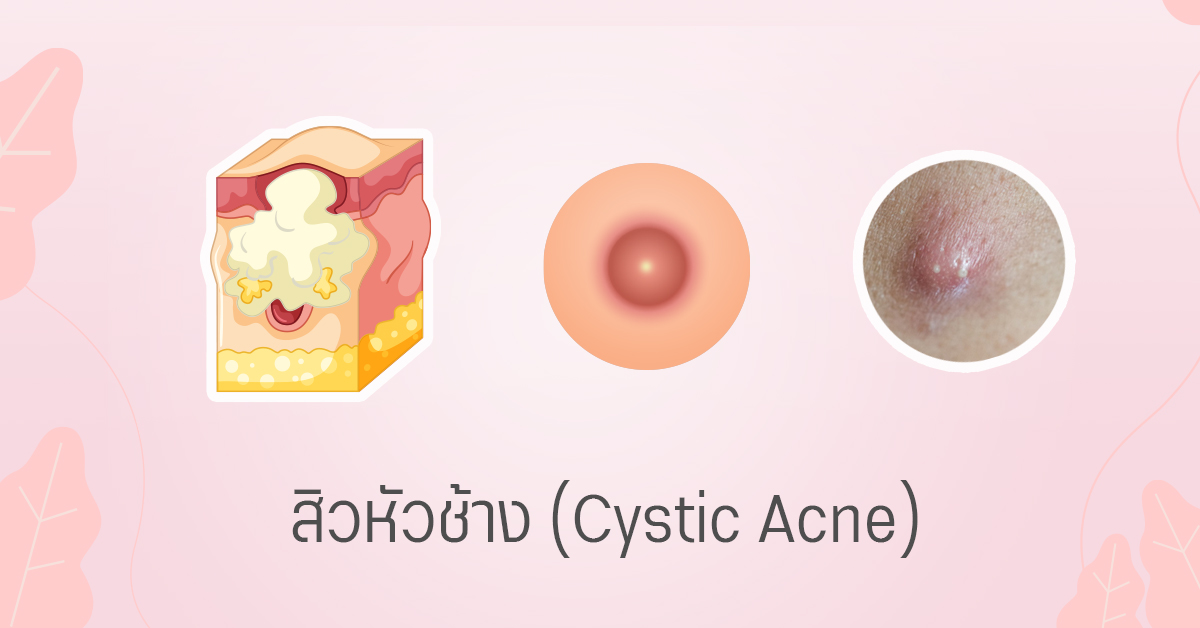 สิวหัวช้าง cystic acne สิวซีสต์