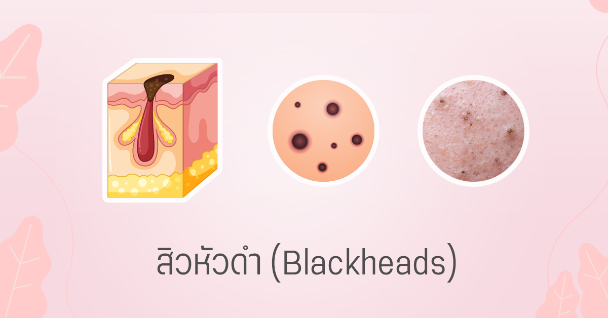 สิวหัวดำ blackheads สิวอุดตันหัวเปิด