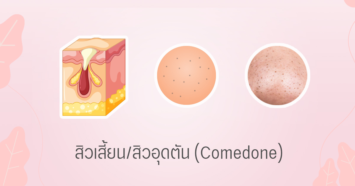 สิวเสี้ยน สิวอุดตัน comedone