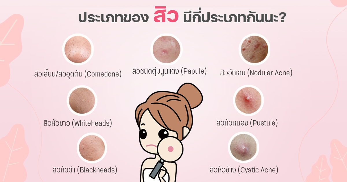 สิวมีกี่ประเภท แผนผังจำแนกประเภทสิว