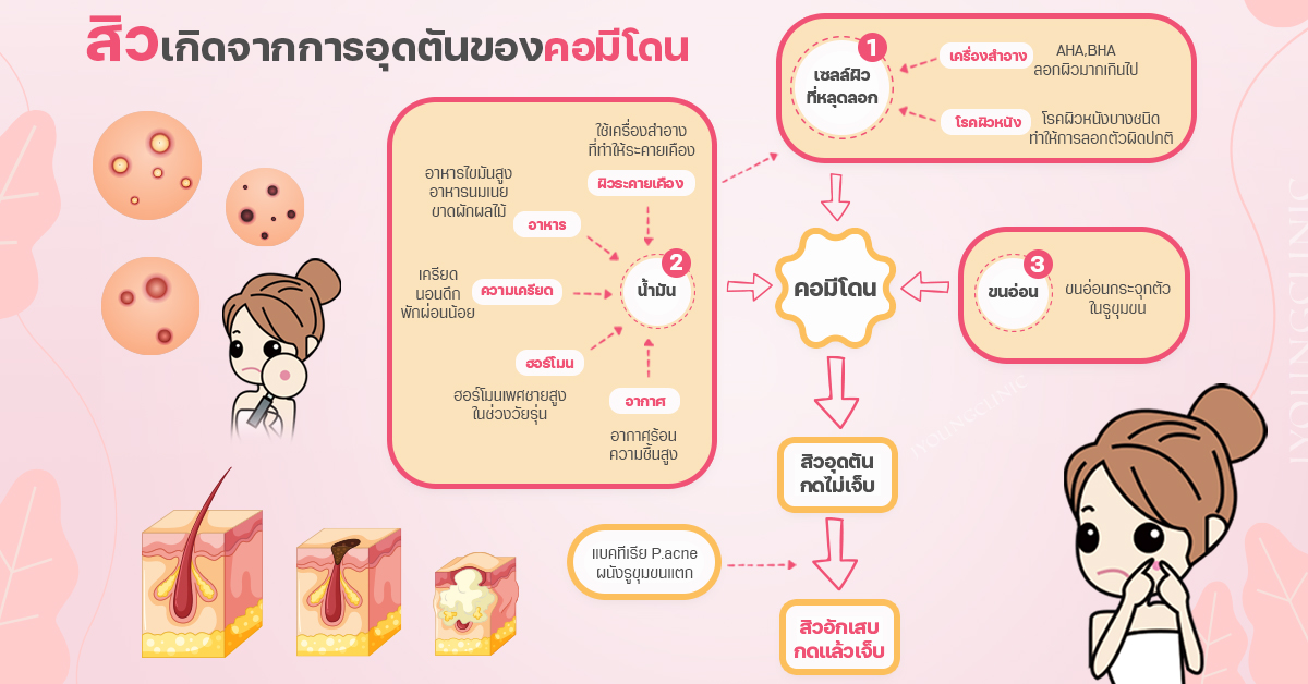 กลไกการเกิดคอมีโดนและการอุดตันของรูขุมขน