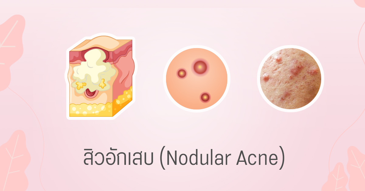 สิวอักเสบ nodular acne สิวไต
