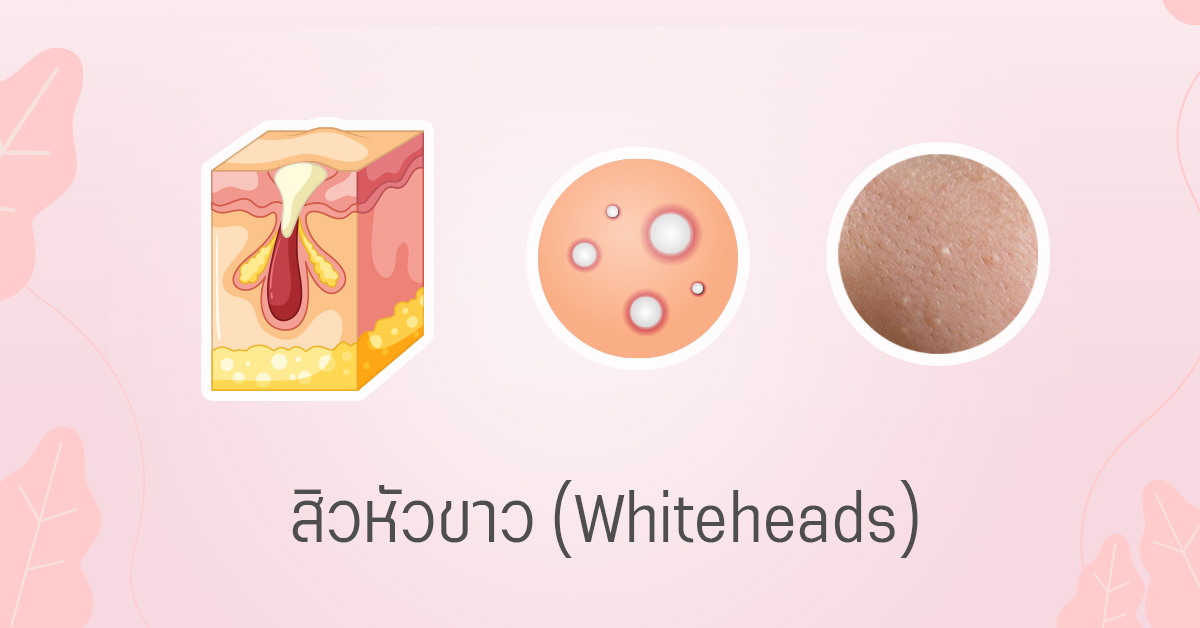 สิวหัวขาว whiteheads สิวอุดตันหัวปิด
