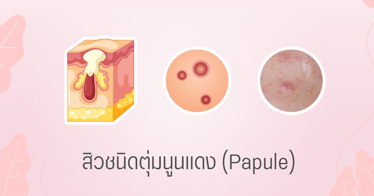 สิวตุ่มนูนแดง papule