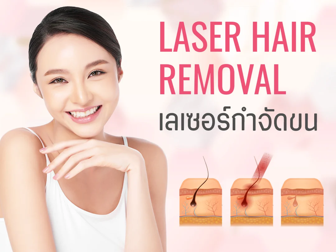กลไกเลเซอร์กำจัดขนและการทำลายเซลล์รากขนอย่างแม่นยำ