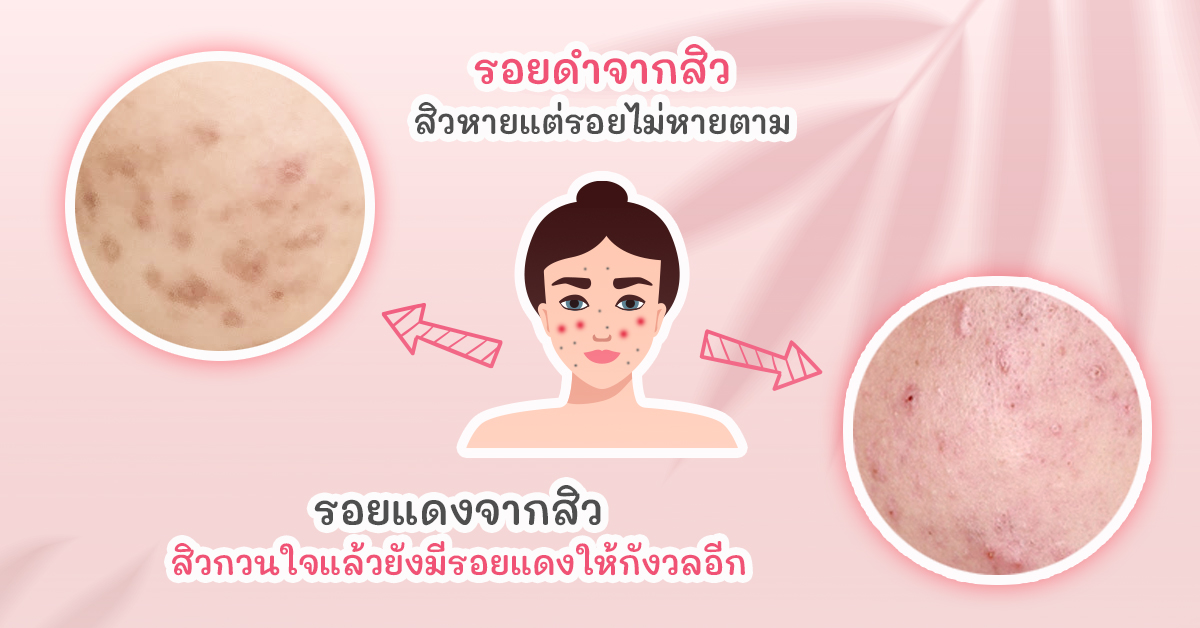 รอยดำและรอยแดงจากสิว กลไกความแตกต่างทางตจวิทยา เจยัง คลินิก
