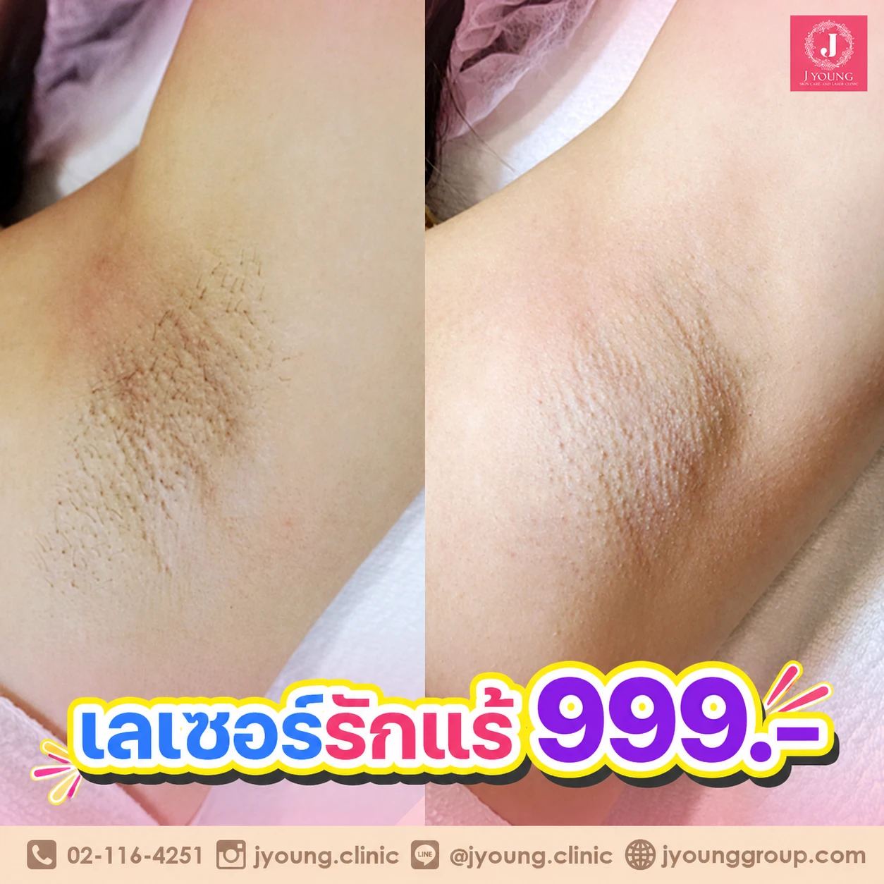 เลเซอร์รักแร้ ราคา 999 บาท เจยัง คลินิก